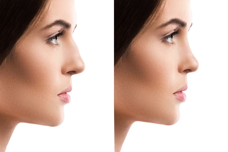 Rinoplastia o cirugía de nariz en Cuernavaca, Morelos